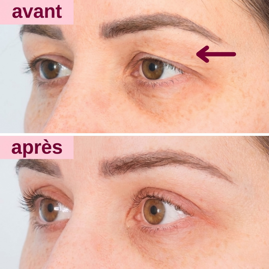 Patch Effet Lifting – Velqoria
