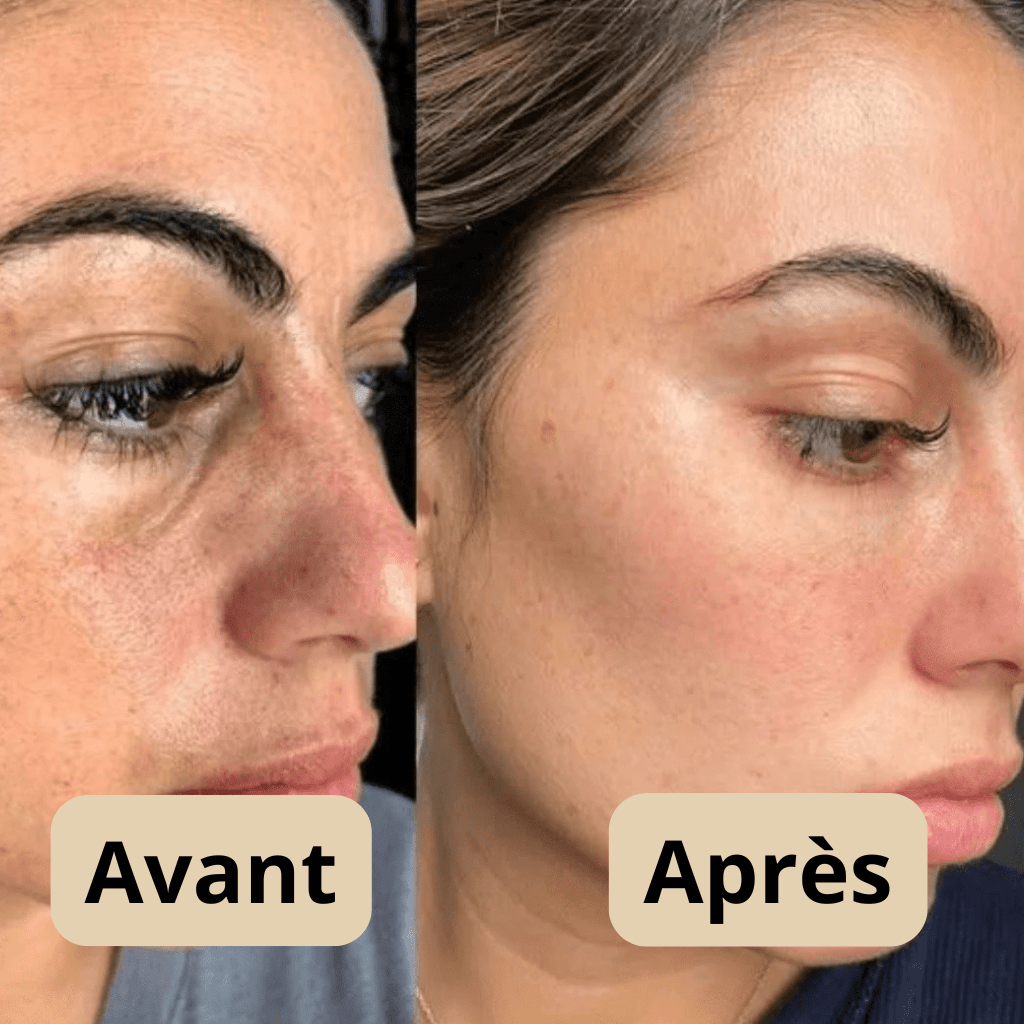 Peel Shot Coréen - Élimine les Impuretés et Sublime Votre Peau